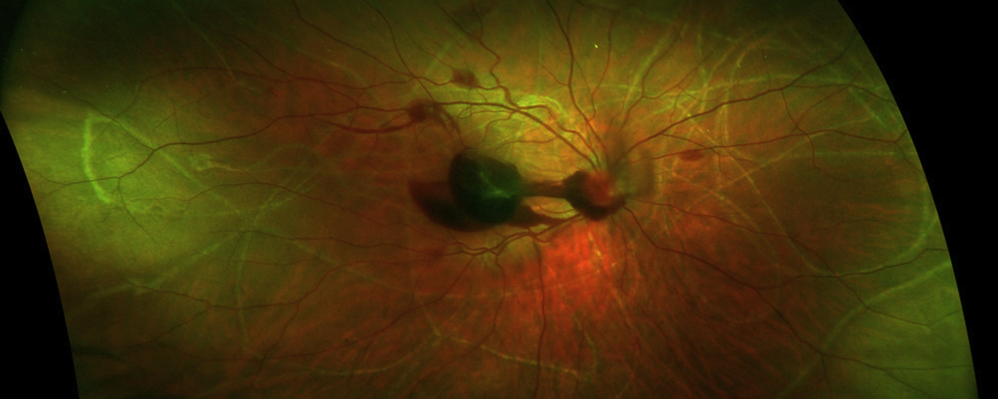 Retina Ten retina10 – Retina Orange County